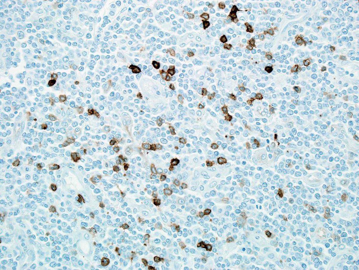 Immunostain for CD117 shows a few positive cells.